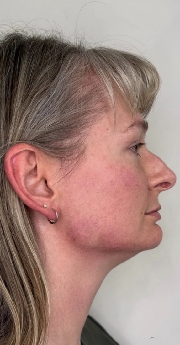 The same profile after dermal filler to the jawline and chin.