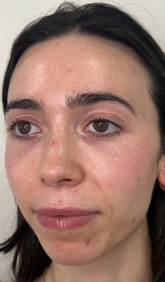 Three-quarter view of a woman's face before treatment.