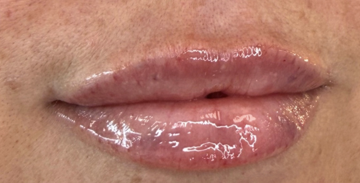 The same lips after lip filler, fuller and more defined.