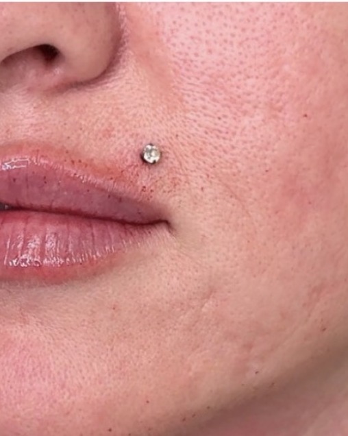 Lip filler result, two weeks after one session