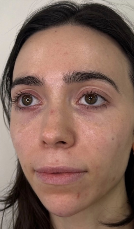 The same face after full facial balancing.