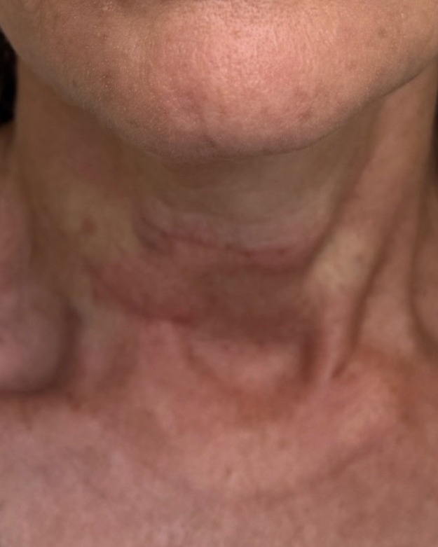 Neck texture, eight weeks after one session