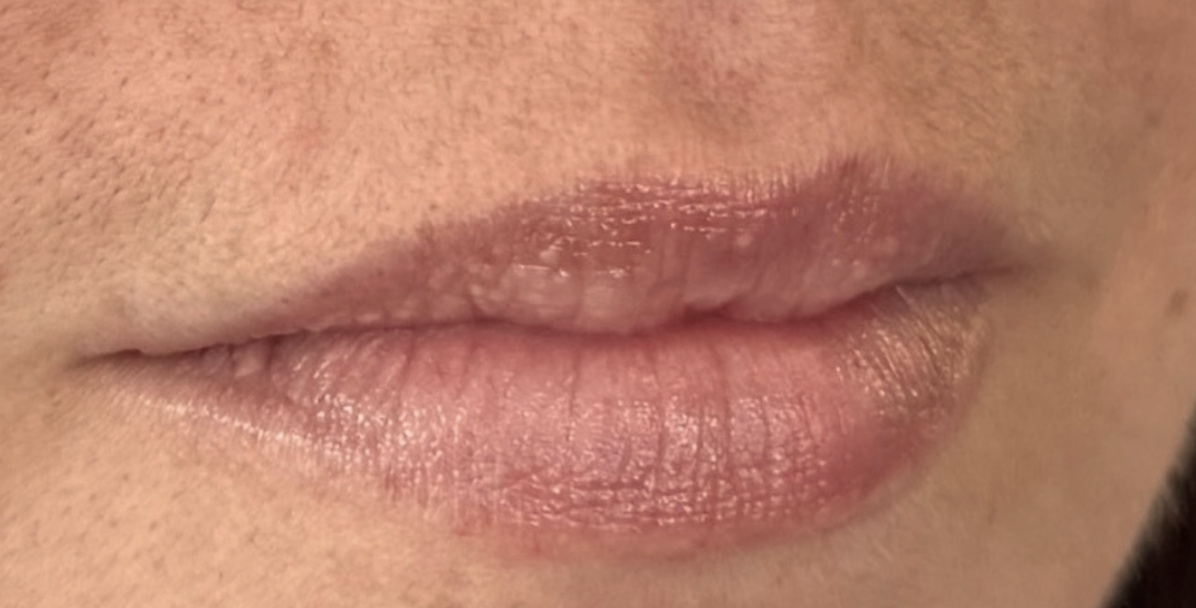 Lips before lip filler.