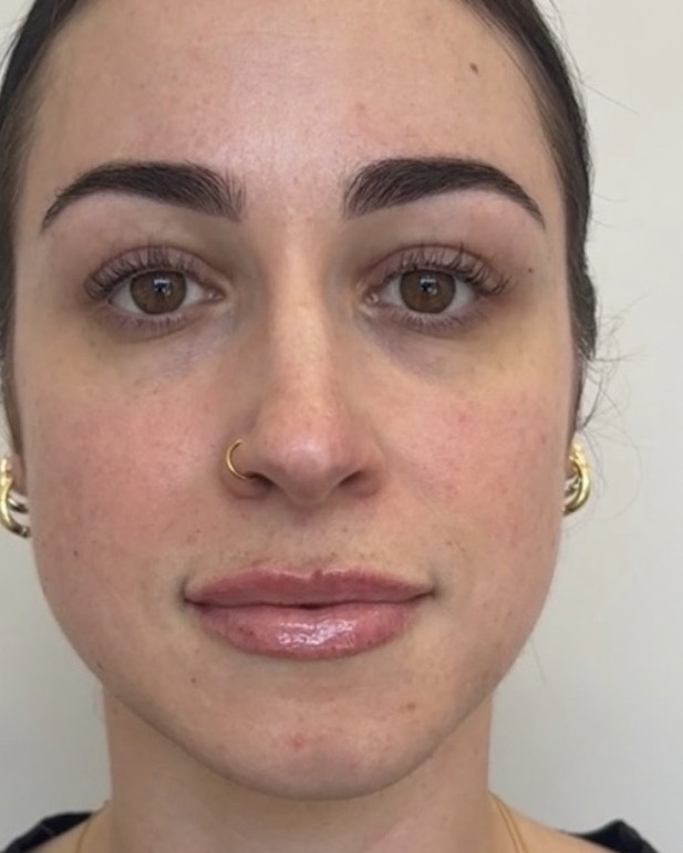 Lip filler result, two weeks after one session