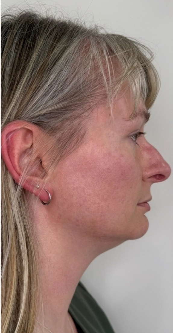 Side profile of the jawline and chin before treatment.