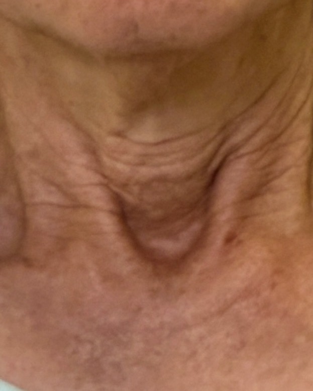 Neck texture, before treatment