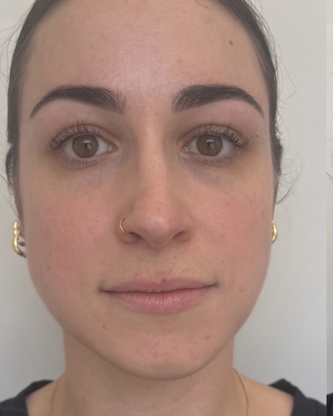 Lip filler result, before treatment